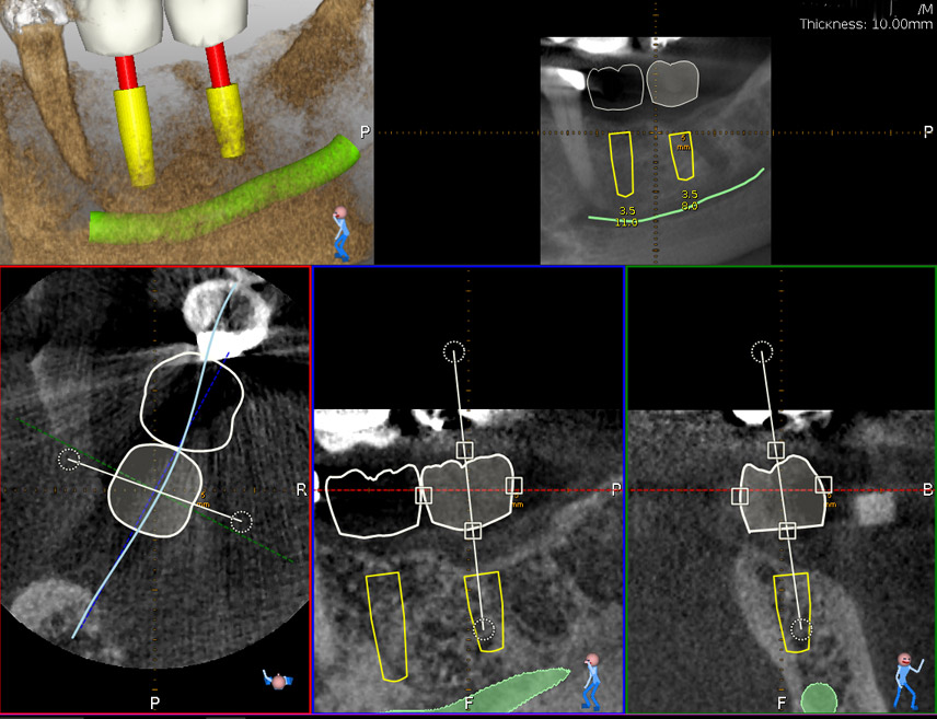 Figure 4: The patient was able to see the proposed treatment displayed by the Navident software