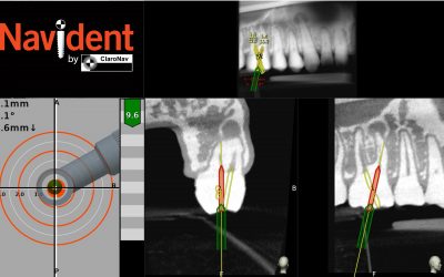 Navident obtains regulatory approvals for guiding root canal treatment