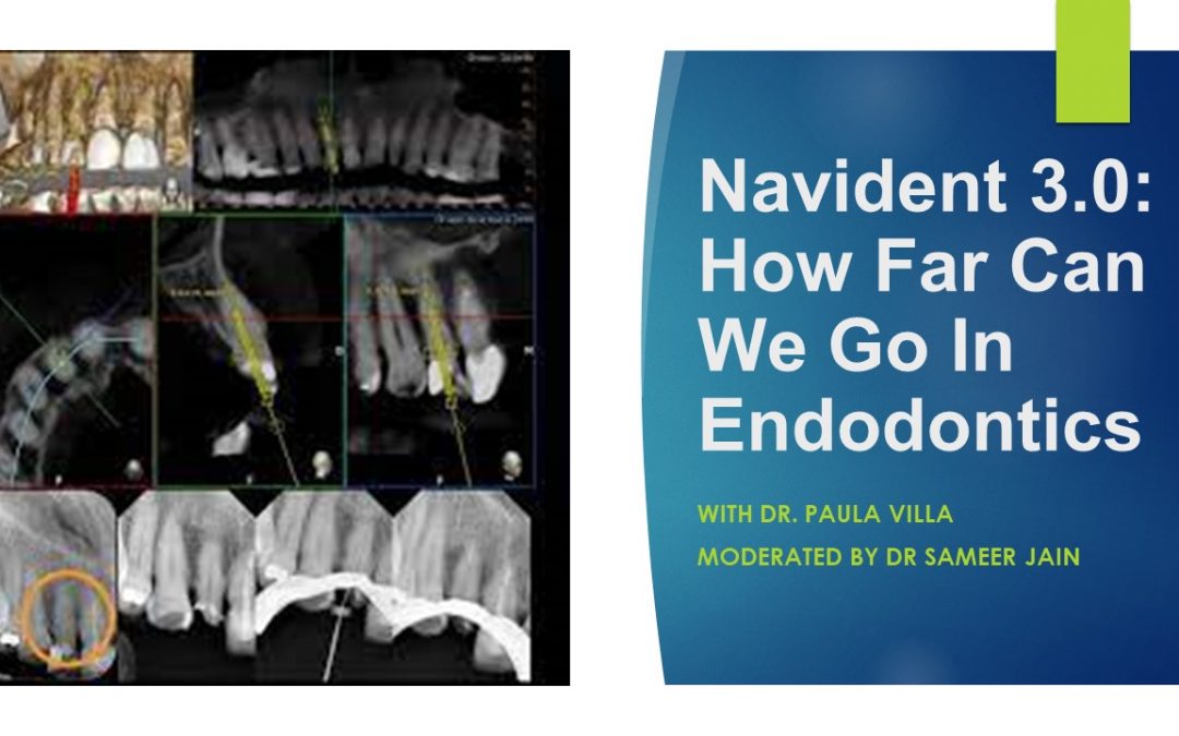 Navident 3.0: How Far Can We Go In Endodontics